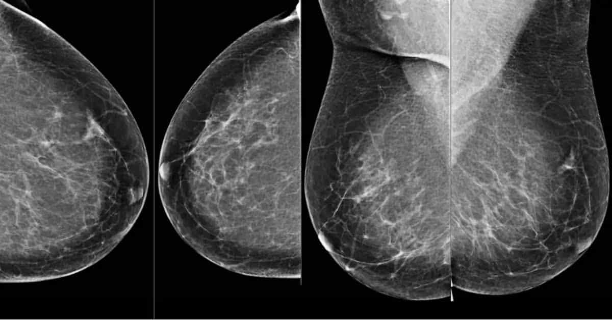 Google's AI outperforms expert radiologists in detecting breast cancer